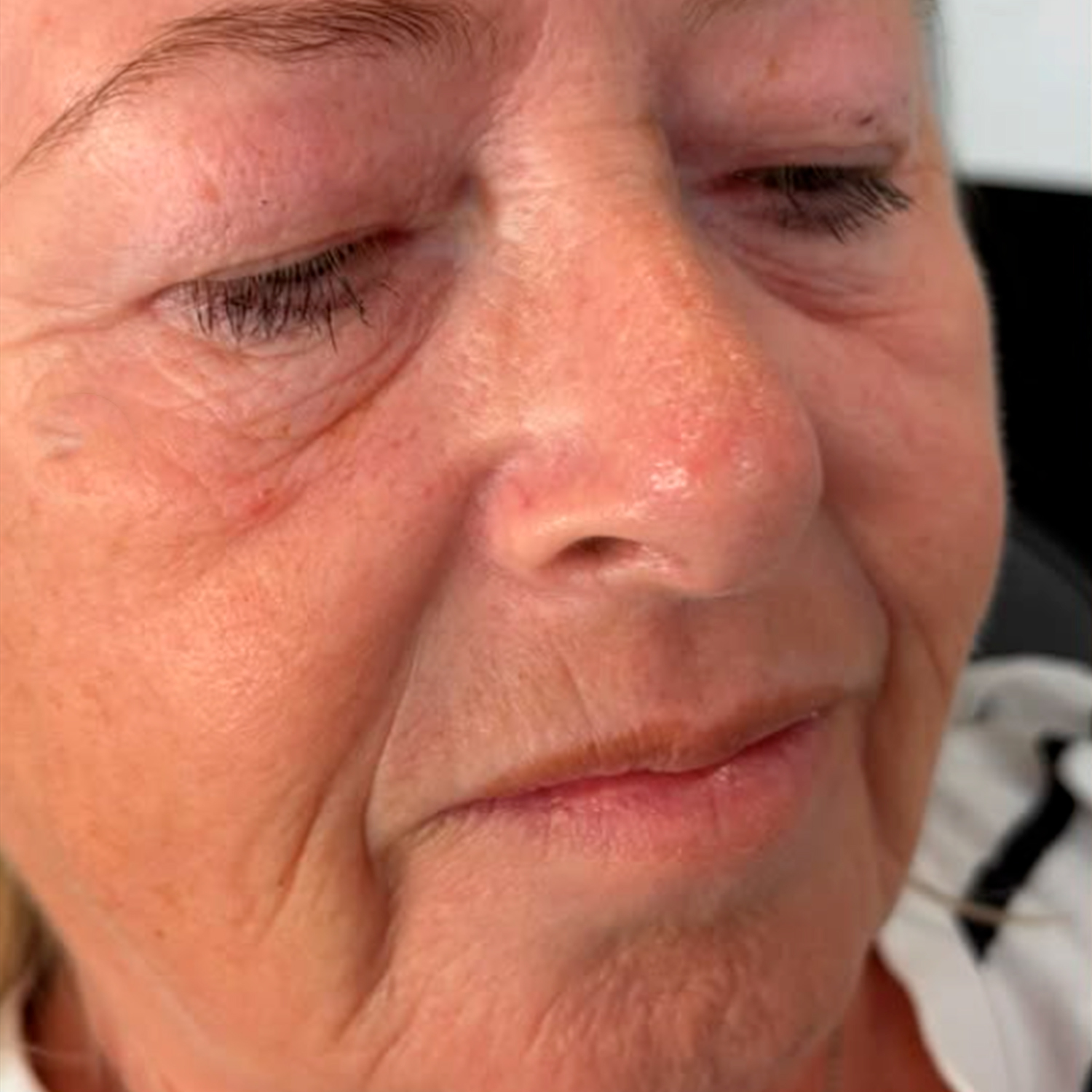 Before full face subtle rejuvenation