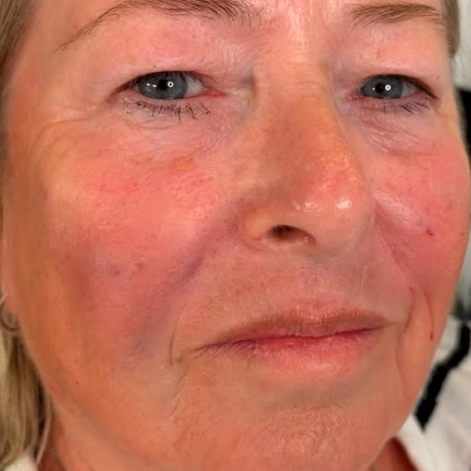 After full face subtle rejuvenation
