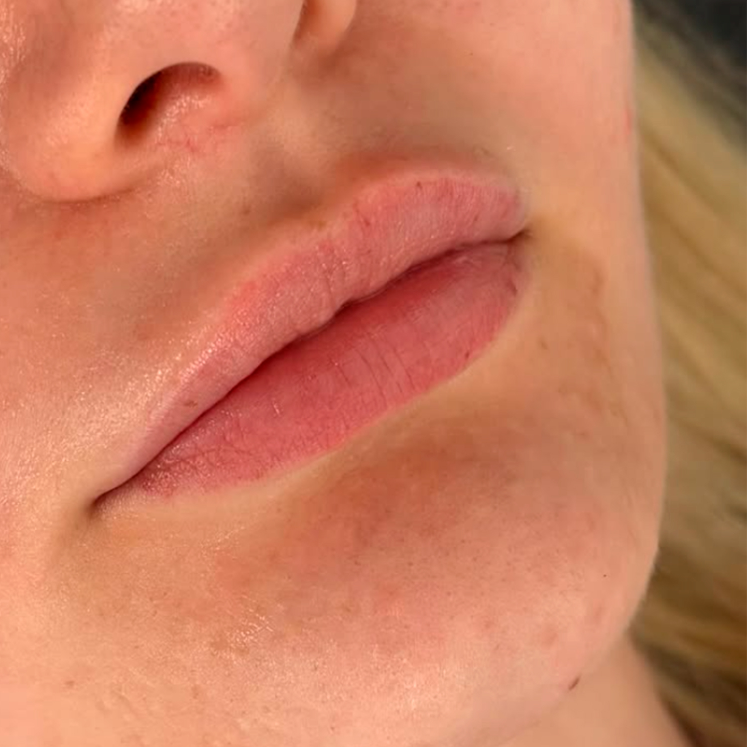 Before treatment result